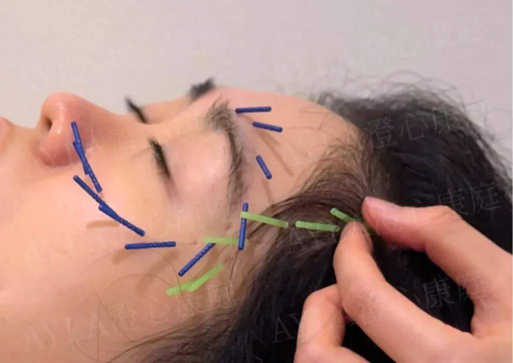 面部抗衰与提升-针灸美容诊疗方案