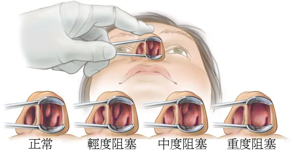 鼻炎（伴鼻息肉）针灸诊疗方案